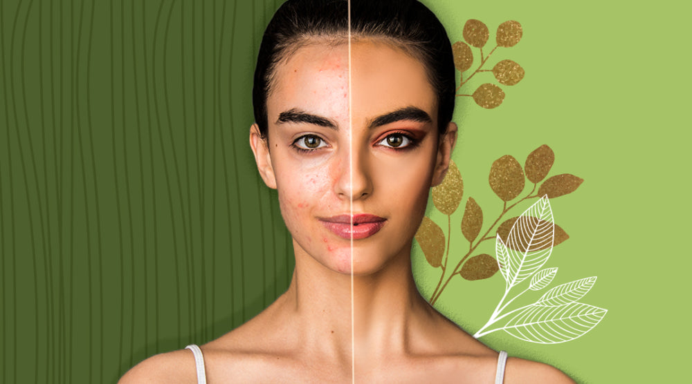 5 Effective Natural Acne Treatments to try right now